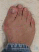 Foot with a bunion.